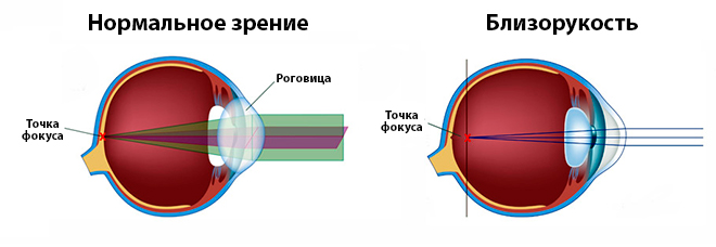 Патологическая близорукость
